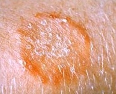 Svamp i huden behandling